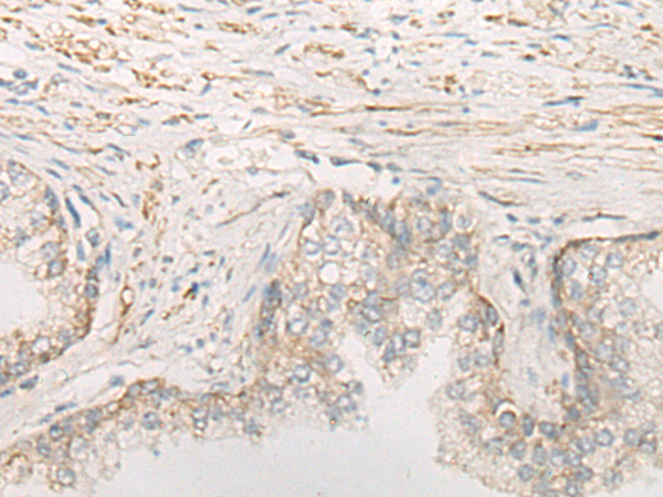 Immunohistochemistry of paraffin-embedded Human prost at e cancer tissue  using STOML2 Polyclonal Antibody at dilution of 1:25(×200)