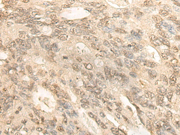 Immunohistochemistry of paraffin-embedded Human colorectal cancer tissue  using BCAS3 Polyclonal Antibody at dilution of 1:35(×200)