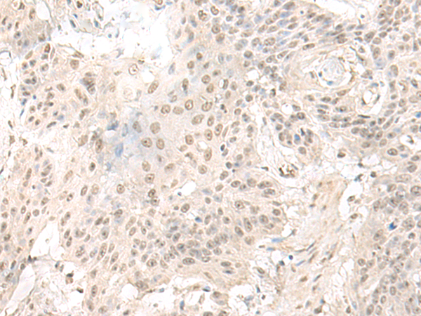Immunohistochemistry of paraffin-embedded Human esophagus cancer tissue  using ILKAP Polyclonal Antibody at dilution of 1:50(×200)