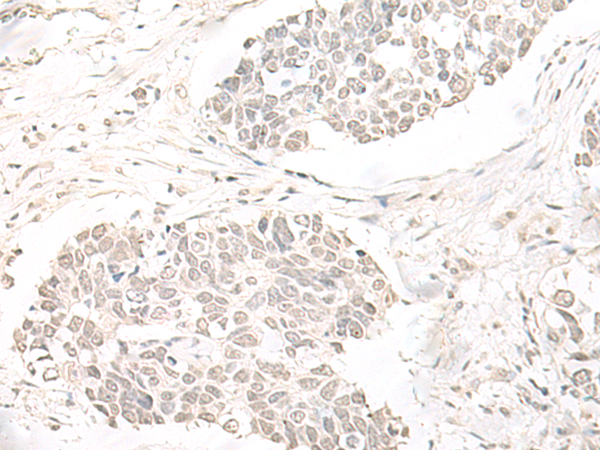 Immunohistochemistry of paraffin-embedded Human lung cancer tissue  using ILKAP Polyclonal Antibody at dilution of 1:50(×200)