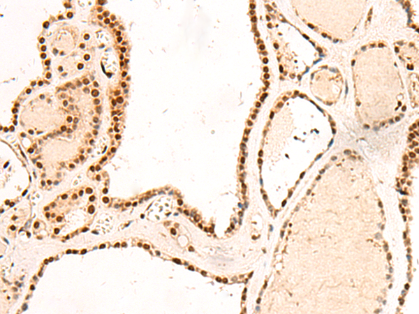 Immunohistochemistry of paraffin-embedded Human thyroid cancer tissue  using RMND5B Polyclonal Antibody at dilution of 1:50(×200)