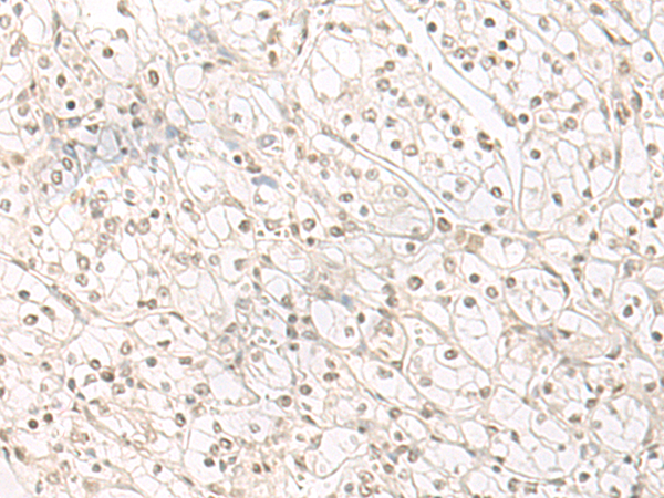 Immunohistochemistry of paraffin-embedded Human kidney cancer tissue  using HENMT1 Polyclonal Antibody at dilution of 1:30(×200)