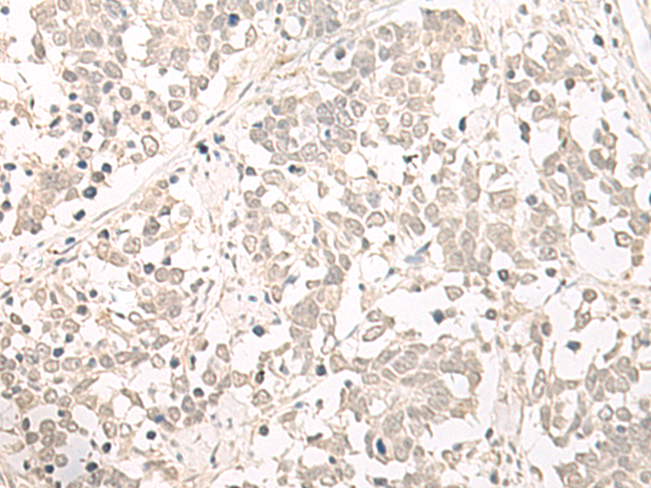 Immunohistochemistry of paraffin-embedded Human lung cancer tissue  using OLA1 Polyclonal Antibody at dilution of 1:55(×200)
