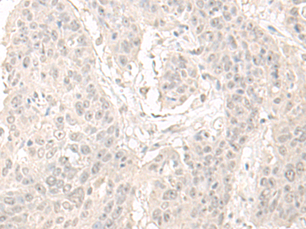 Immunohistochemistry of paraffin-embedded Human esophagus cancer tissue  using OLA1 Polyclonal Antibody at dilution of 1:55(×200)