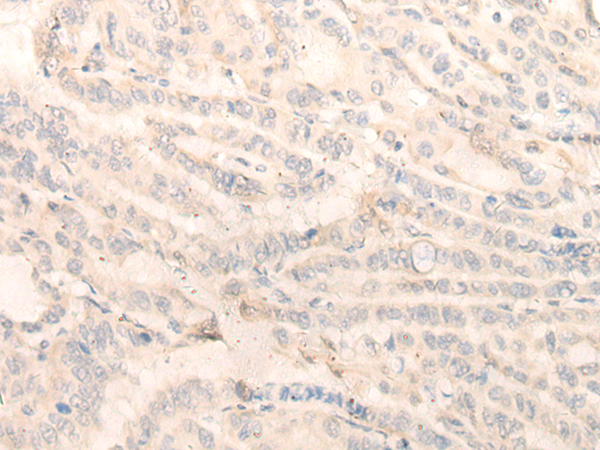 Immunohistochemistry of paraffin-embedded Human thyroid cancer tissue  using INPP1 Polyclonal Antibody at dilution of 1:35(×200)