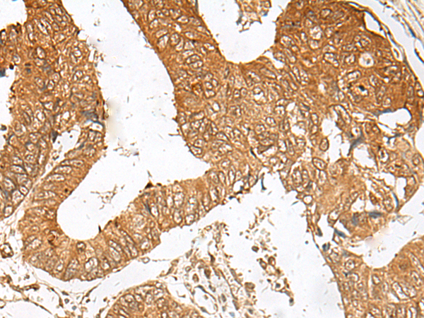 Immunohistochemistry of paraffin-embedded Human colorectal cancer tissue  using ZBTB8A Polyclonal Antibody at dilution of 1:100(×200)