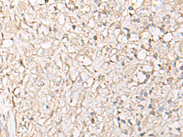 Immunohistochemistry of paraffin-embedded Human ovarian cancer tissue  using IGHA1 Polyclonal Antibody at dilution of 1:65(×200)