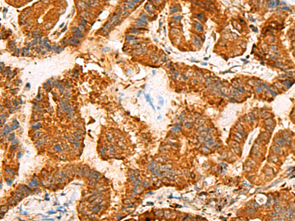 Immunohistochemistry of paraffin-embedded Human thyroid cancer tissue  using ASMTL Polyclonal Antibody at dilution of 1:100(×200)