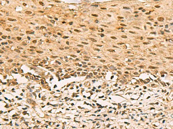 Immunohistochemistry of paraffin-embedded Human cervical cancer tissue  using SCMH1 Polyclonal Antibody at dilution of 1:120(×200)