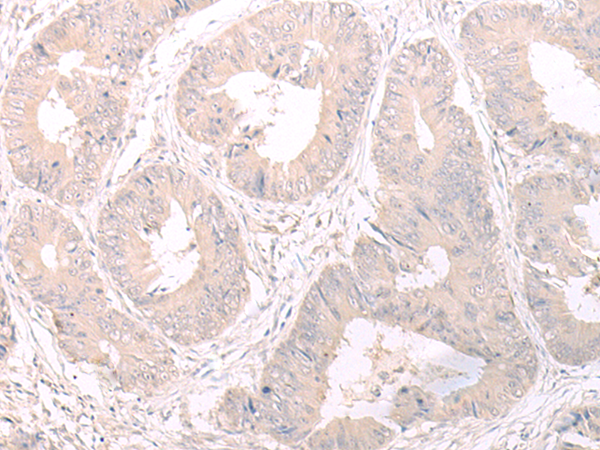 Immunohistochemistry of paraffin-embedded Human colorectal cancer tissue  using FOXRED2 Polyclonal Antibody at dilution of 1:35(×200)