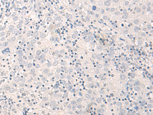 Immunohistochemistry of paraffin-embedded Human cervical cancer tissue  using THOP1 Polyclonal Antibody at dilution of 1:35(×200)