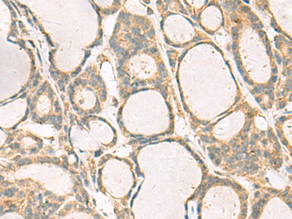 Immunohistochemistry of paraffin-embedded Human thyroid cancer tissue  using KIF2C Polyclonal Antibody at dilution of 1:70(×200)