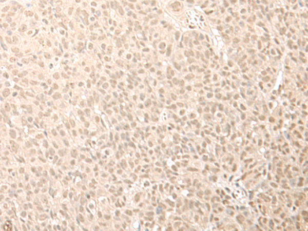 Immunohistochemistry of paraffin-embedded Human esophagus cancer tissue  using CNOT10 Polyclonal Antibody at dilution of 1:50(×200)