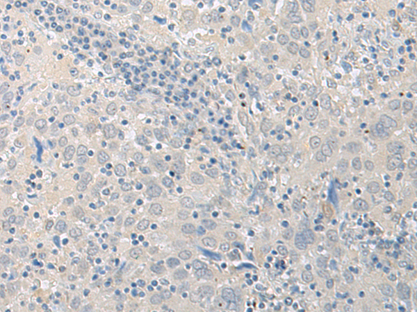 Immunohistochemistry of paraffin-embedded Human cervical cancer tissue  using LYRM2 Polyclonal Antibody at dilution of 1:50(×200)