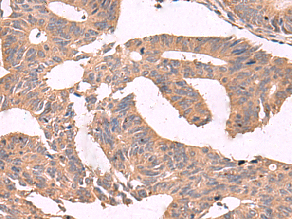 Immunohistochemistry of paraffin-embedded Human colorectal cancer tissue  using MGP Polyclonal Antibody at dilution of 1:75(×200)