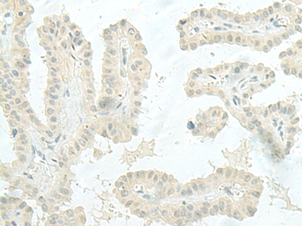 Immunohistochemistry of paraffin-embedded Human thyroid cancer tissue  using MIEN1 Polyclonal Antibody at dilution of 1:45(×200)