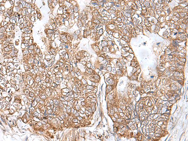 Immunohistochemistry of paraffin-embedded Human gastric cancer tissue  using RNF111 Polyclonal Antibody at dilution of 1:50(×200)