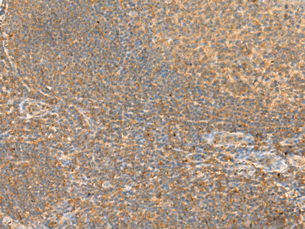 Immunohistochemistry of paraffin-embedded Human tonsil tissue  using RAC3 Polyclonal Antibody at dilution of 1:45(×200)