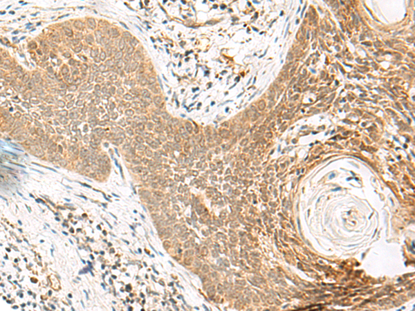 Immunohistochemistry of paraffin-embedded Human esophagus cancer tissue  using ORC4 Polyclonal Antibody at dilution of 1:80(×200)