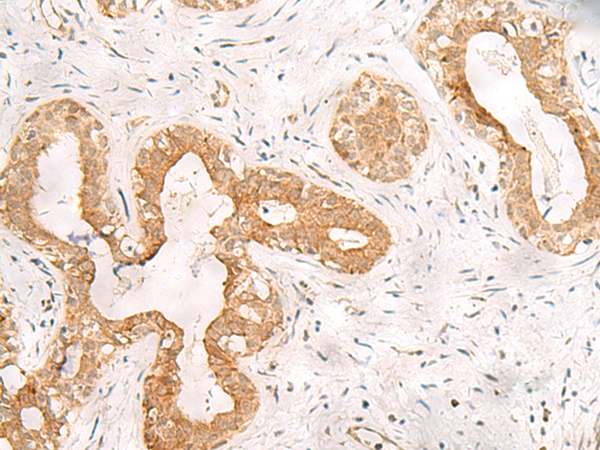 Immunohistochemistry of paraffin-embedded Human breast cancer tissue  using ORC4 Polyclonal Antibody at dilution of 1:80(×200)