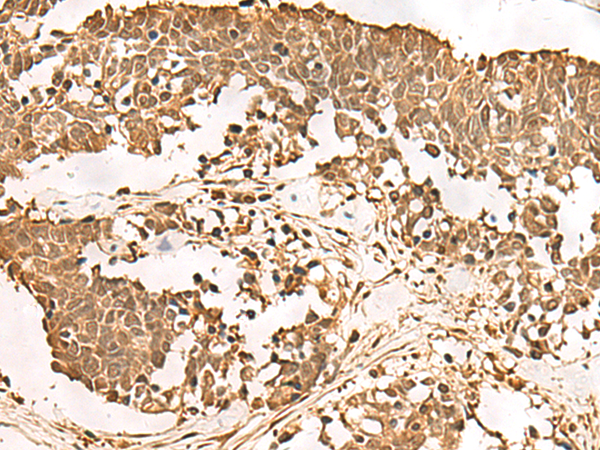 Immunohistochemistry of paraffin-embedded Human lung cancer tissue  using PSMA3 Polyclonal Antibody at dilution of 1:50(×200)