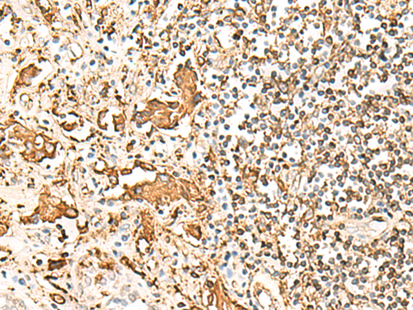 Immunohistochemistry of paraffin-embedded Human prost at e cancer tissue  using HLA-DRB1 Polyclonal Antibody at dilution of 1:75(×200)