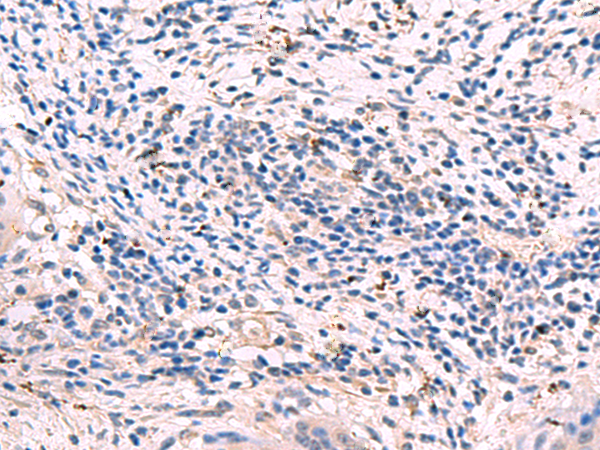 Immunohistochemistry of paraffin-embedded Human cervical cancer tissue  using GKAP1 Polyclonal Antibody at dilution of 1:95(×200)