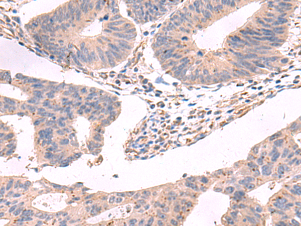 Immunohistochemistry of paraffin-embedded Human colorectal cancer tissue  using GKAP1 Polyclonal Antibody at dilution of 1:95(×200)