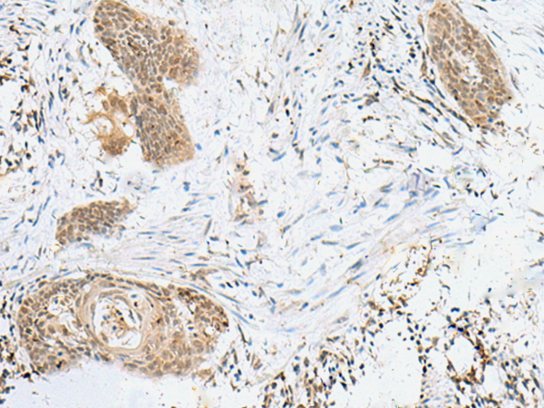 Immunohistochemistry of paraffin-embedded Human esophagus cancer tissue  using LPXN Polyclonal Antibody at dilution of 1:60(×200)