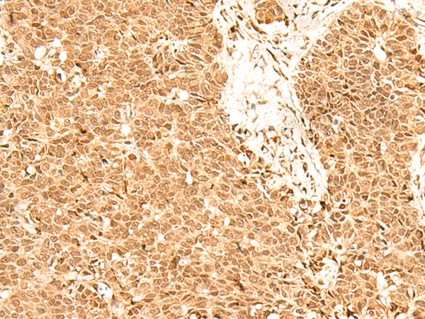 Immunohistochemistry of paraffin-embedded Human ovarian cancer tissue  using ADRM1 Polyclonal Antibody at dilution of 1:70(×200)