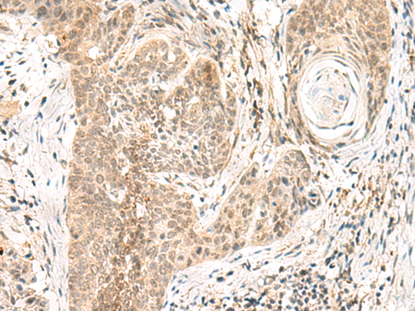 Immunohistochemistry of paraffin-embedded Human esophagus cancer tissue  using GPSM1 Polyclonal Antibody at dilution of 1:55(×200)