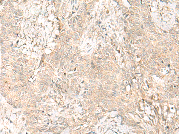 Immunohistochemistry of paraffin-embedded Human ovarian cancer tissue  using GPSM1 Polyclonal Antibody at dilution of 1:55(×200)