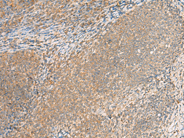 Immunohistochemistry of paraffin-embedded Human tonsil tissue  using EXD2 Polyclonal Antibody at dilution of 1:55(×200)