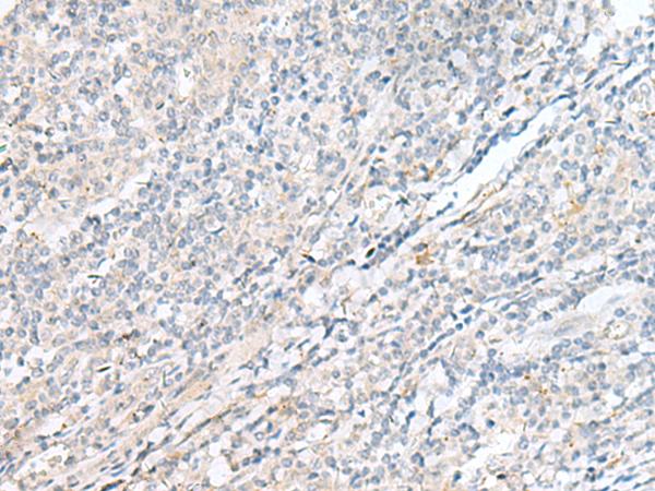 Immunohistochemistry of paraffin-embedded Human tonsil tissue  using POMGNT1 Polyclonal Antibody at dilution of 1:55(×200)