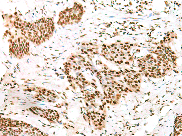 Immunohistochemistry of paraffin-embedded Human esophagus cancer tissue  using TCOF1 Polyclonal Antibody at dilution of 1:50(×200)