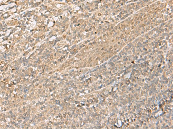 Immunohistochemistry of paraffin-embedded Human tonsil tissue  using IPO11 Polyclonal Antibody at dilution of 1:70(×200)