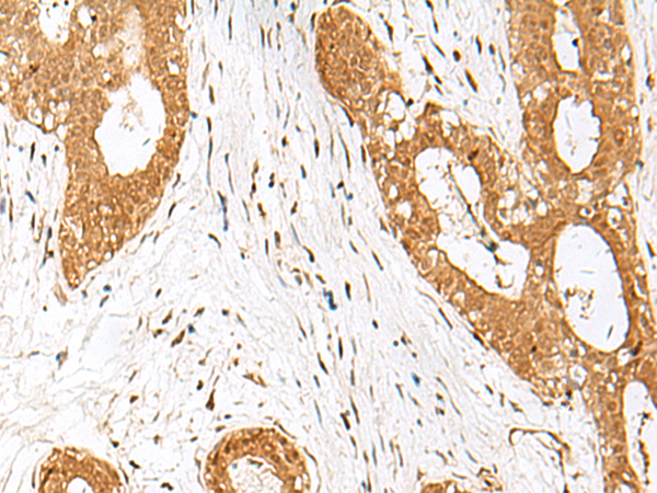 Immunohistochemistry of paraffin-embedded Human breast cancer tissue  using IPO11 Polyclonal Antibody at dilution of 1:70(×200)
