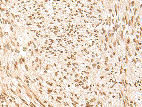 Immunohistochemistry of paraffin-embedded Human liver cancer tissue  using POM121 Polyclonal Antibody at dilution of 1:75(×200)