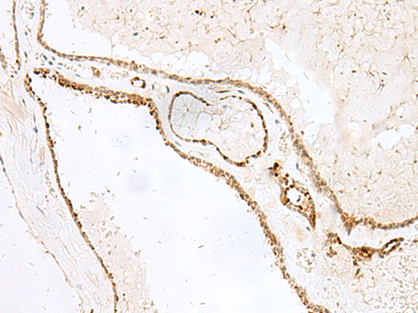 Immunohistochemistry of paraffin-embedded Human thyroid cancer tissue  using GSKIP Polyclonal Antibody at dilution of 1:55(×200)