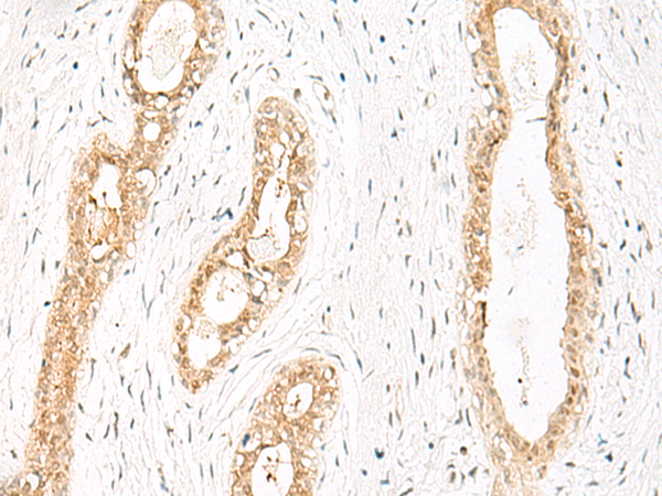 Immunohistochemistry of paraffin-embedded Human breast cancer tissue  using JPT1 Polyclonal Antibody at dilution of 1:35(×200)