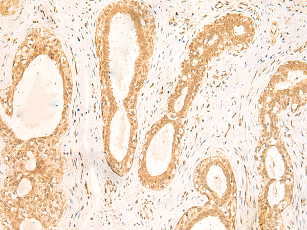 Immunohistochemistry of paraffin-embedded Human breast cancer tissue  using ST8SIA4 Polyclonal Antibody at dilution of 1:50(×200)