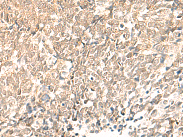 Immunohistochemistry of paraffin-embedded Human lung cancer tissue  using TBPL1 Polyclonal Antibody at dilution of 1:50(×200)