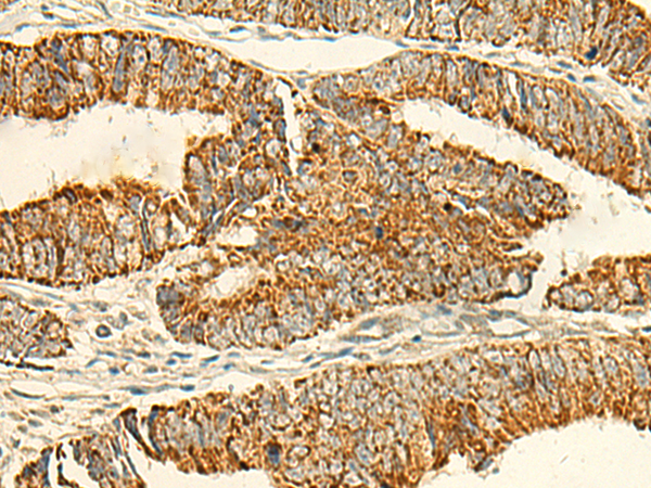 Immunohistochemistry of paraffin-embedded Human colorectal cancer tissue  using IFT27 Polyclonal Antibody at dilution of 1:50(×200)