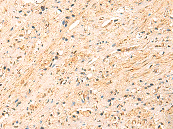 Immunohistochemistry of paraffin-embedded Human prost at e cancer tissue  using EEF1AKMT2 Polyclonal Antibody at dilution of 1:50(×200)