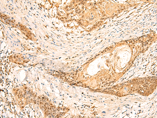 Immunohistochemistry of paraffin-embedded Human esophagus cancer tissue  using EEF1AKMT2 Polyclonal Antibody at dilution of 1:50(×200)