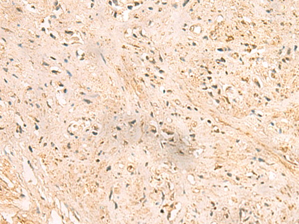 Immunohistochemistry of paraffin-embedded Human prost ate cancer tissue  using SSSCA1 Polyclonal Antibody at dilution of 1:50(×200)