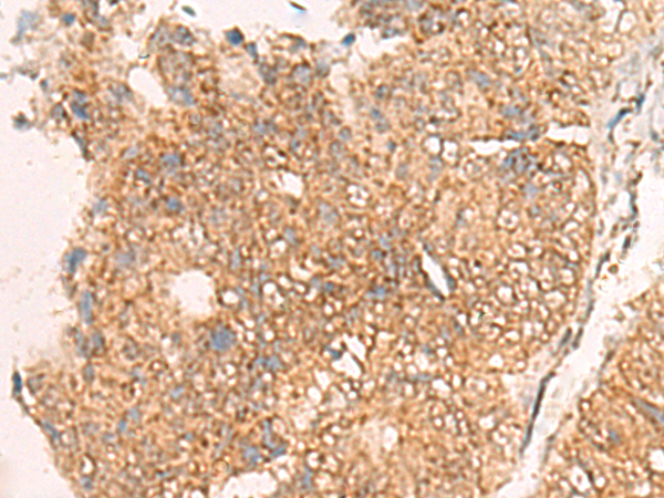 Immunohistochemistry of paraffin-embedded Human colorectal cancer tissue  using MOB1A Polyclonal Antibody at dilution of 1:50(×200)