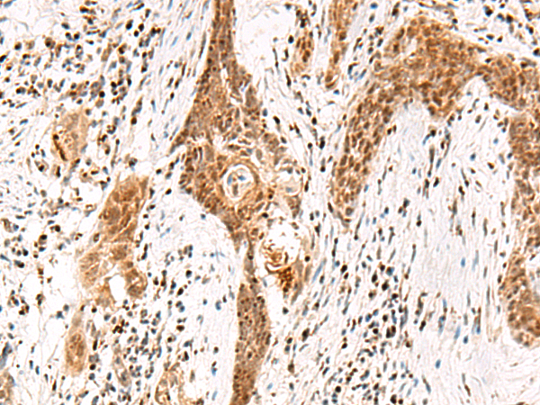 Immunohistochemistry of paraffin-embedded Human esophagus cancer tissue  using DGCR6L Polyclonal Antibody at dilution of 1:65(×200)