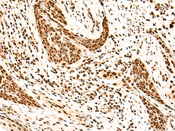 Immunohistochemistry of paraffin-embedded Human esophagus cancer tissue  using SNRPB2 Polyclonal Antibody at dilution of 1:75(×200)