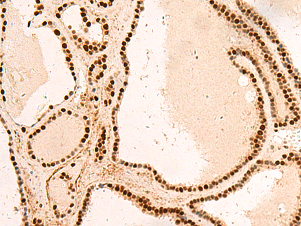 Immunohistochemistry of paraffin-embedded Human thyroid cancer tissue  using SNRPB2 Polyclonal Antibody at dilution of 1:75(×200)